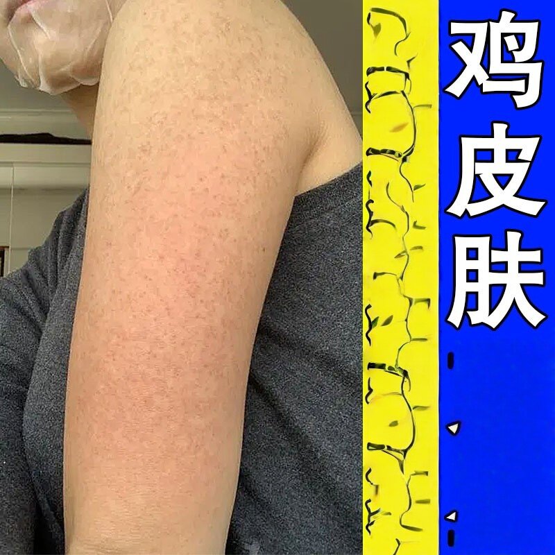 改善鸡皮手臂脸上腿部胳膊红点黑点膏去除毛周角化疙瘩毛囊乳膏