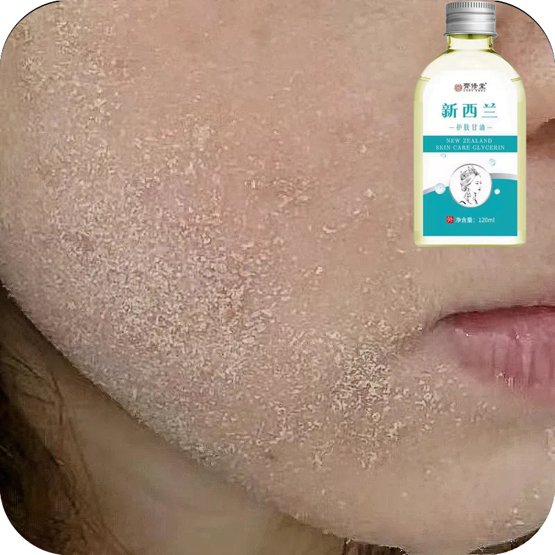 脸上干燥起皮干皮脸干掉皮秋冬季脸上脱皮爆皮脸干起皮干燥脸干痒