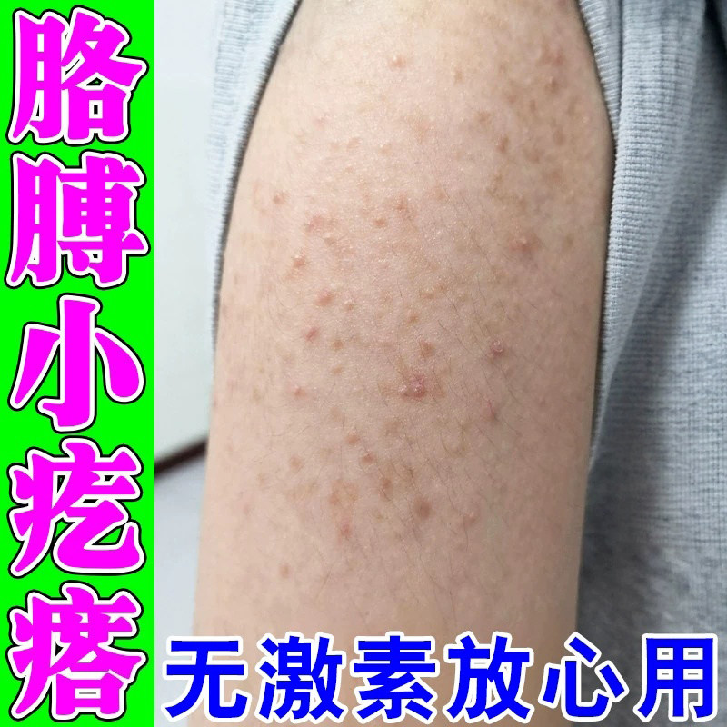 胳膊上起小疙瘩手臂毛囊炎长痘痘鸡皮肤去除毛囊角化角质药专用膏