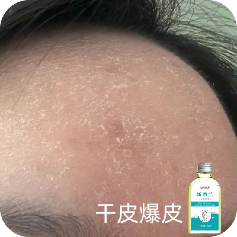 脸上起皮掉皮干皮脸上起皮干燥脸干掉皮秋冬季脸干起皮干燥脸干痒