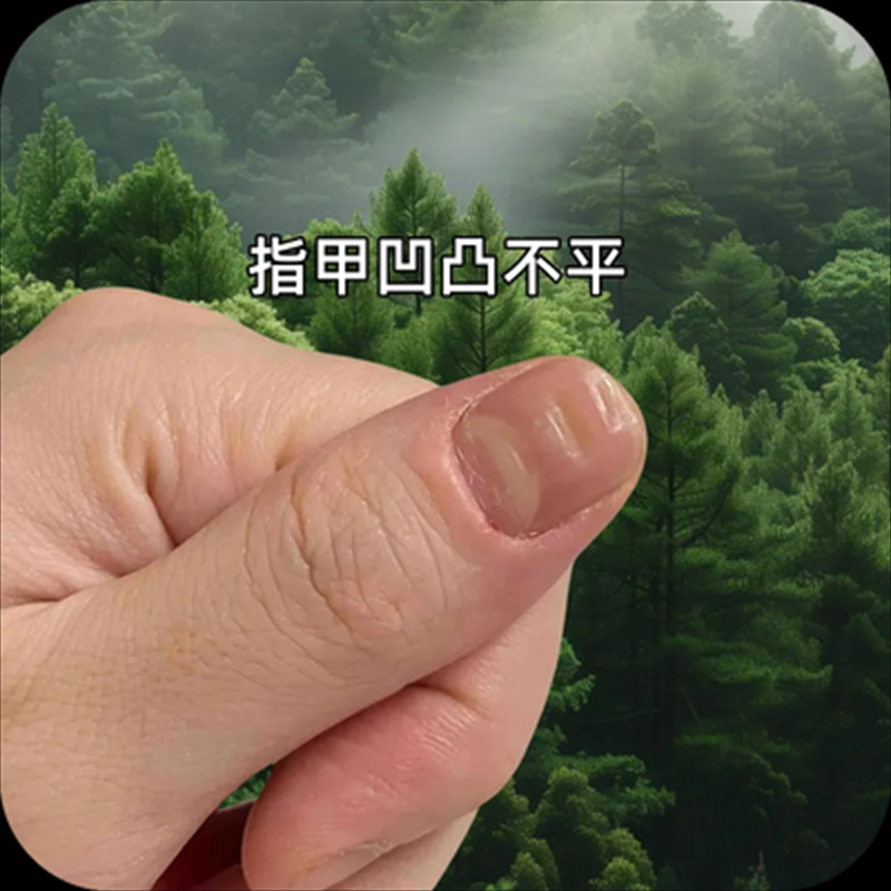 大拇指甲凹凸不平指甲瘀血竖纹竖线真菌感染甲母痣灰指甲甲肉分离
