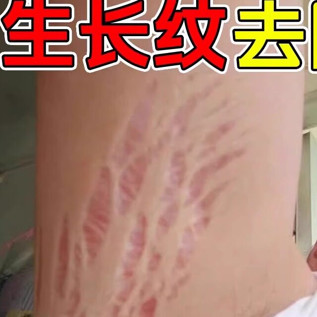 去肥胖纹修复霜生长纹消除大腿学生腰腹上肥胖纹去除男女通用药膏