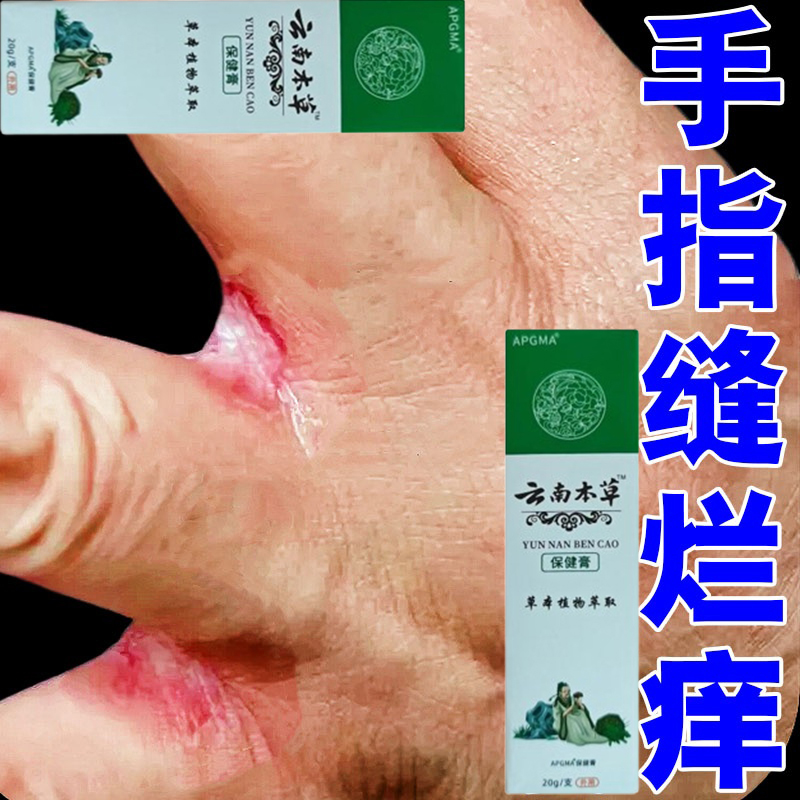 手指缝溃烂药膏经常碰水烂手丫洗洁精过敏指缝糜烂脱皮痒修复膏药