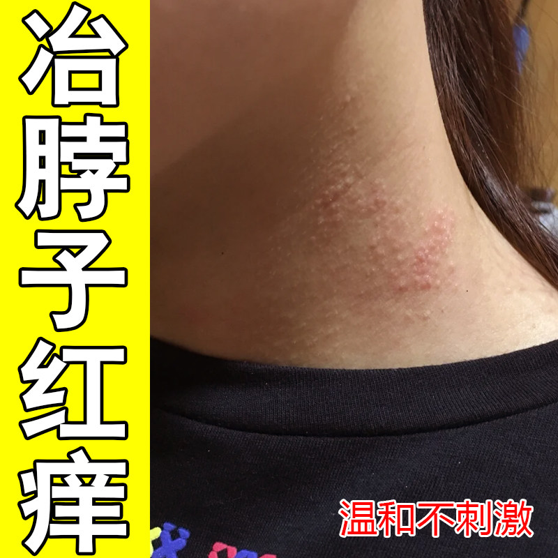 冶脖子红痒脖圈红肿过敏粗糙干燥红点过敏神经起疹子粗糙修复保湿