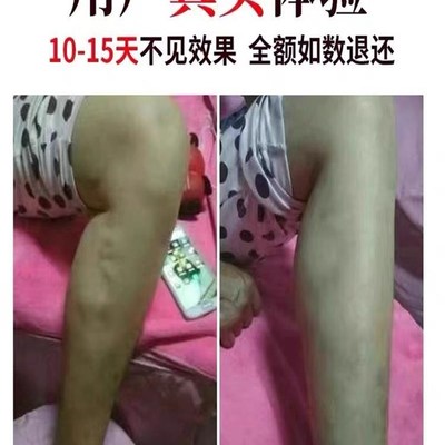 新品【当晚见效】腿部曲张特效专用膏青筋凸起严重蚯蚓腿老烂腿平