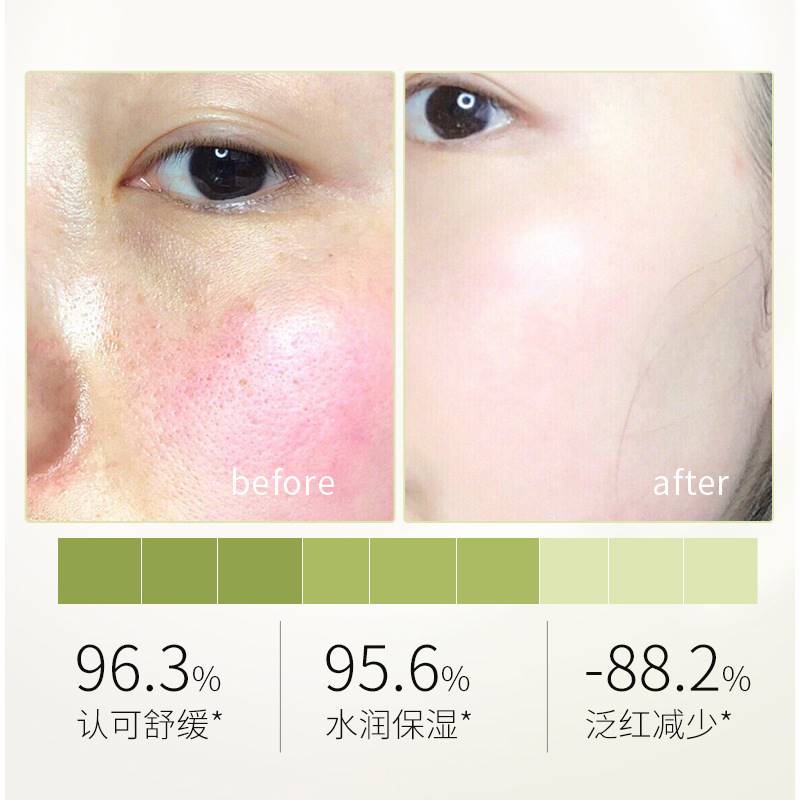 面油去脸上的鼻子红血丝激素脸修复去除护肤品增厚角质层皮肤屏障