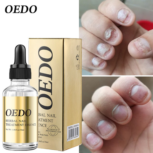 极速Fungal Nail Treatment Essential Oil Hand and Foot Whiten
