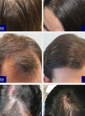 好货Fast Hair Growth Hair Follicle Treatment Hair Growth Seb