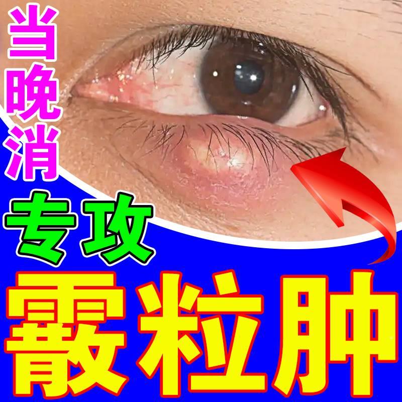 霰粒肿热敷眼膜麦粒肿散粒肿眼睑板腺堵塞疏通眼皮痒跳涌泉痉挛贴