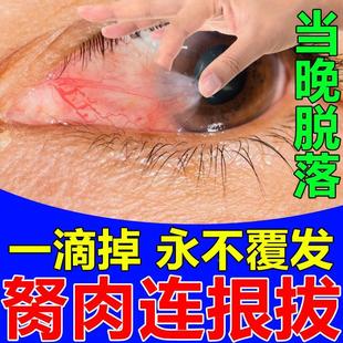 去除眼睛胬肉翼状滴眼液眼睛长胬肉息肉异物感眼干痒模糊疲劳药水