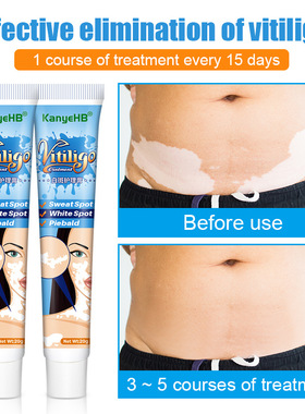 20g Herbal Extract Vitiligo Ointment Remove Ringworm White S