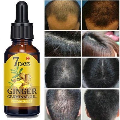 Hair Loss Treatment Ginger Growth Essence Oil老姜头发养护油