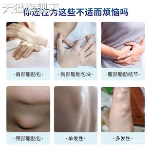 旗舰店官方正品脂肪康夏枯草抑菌膏结节缓解脂肪包块皮下硬块结节