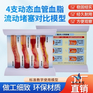血管仿真堵塞血脂高血脂模型病理动态动脉硬化血栓直观教学流动