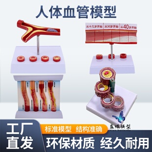 人体心血管层次结构解剖堵塞模型血栓脂肪病理动静脉放大硬化教具