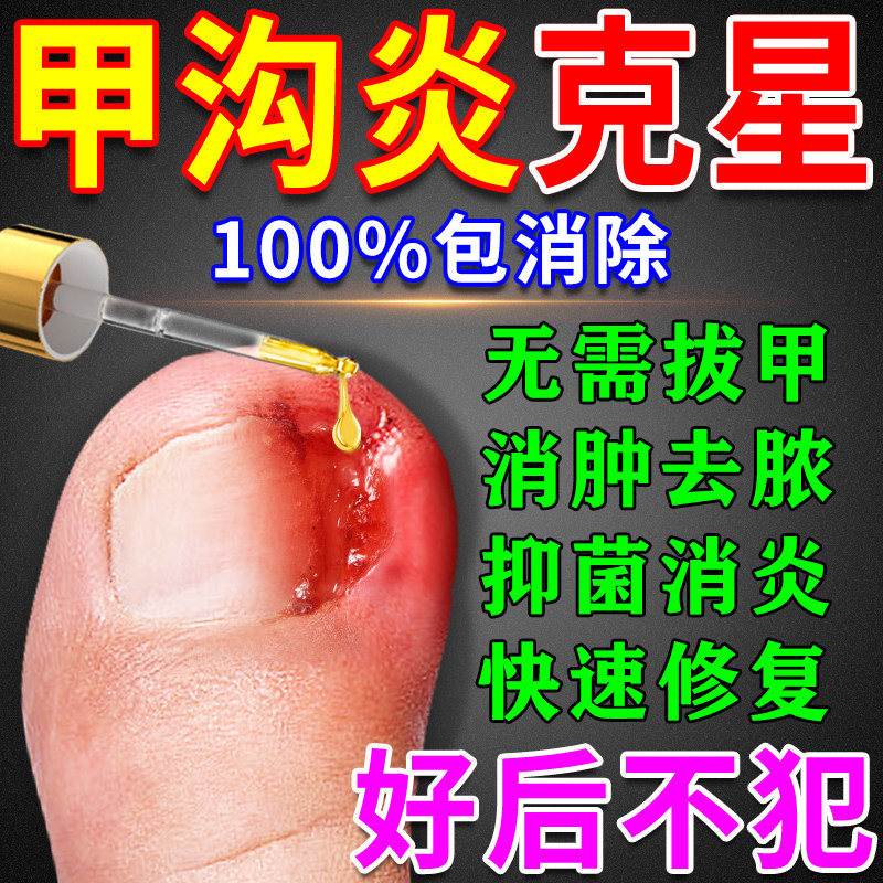 甲沟炎辅助治疗息肉脓包专用膏药大拇指去肉芽消肿化脓特有效神器