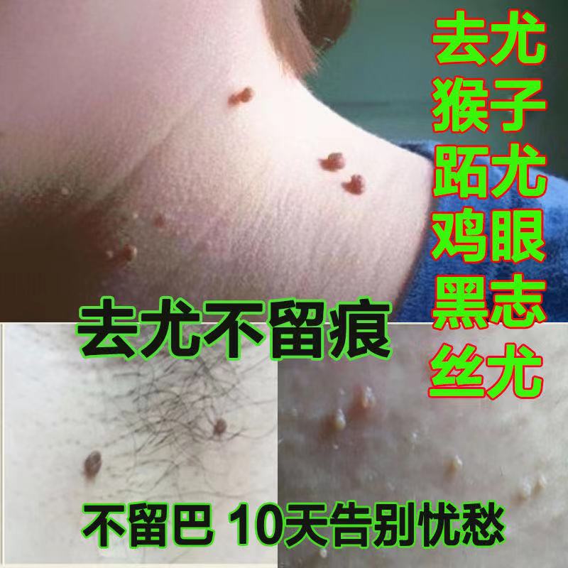 点立净清尤灵去皮赘肉瘤猴子脖子上长的小肉粒疙瘩点尤药肉血痣膏