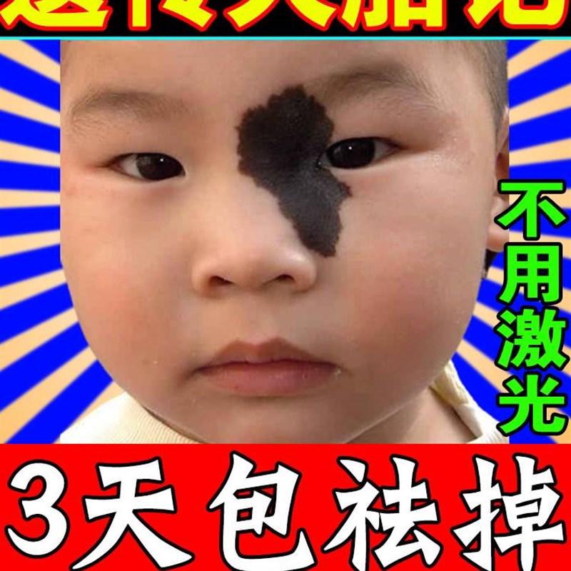 【当晚显效】去胎记除胎记脸部黑色素天生黑淡化红色咖啡斑神器药