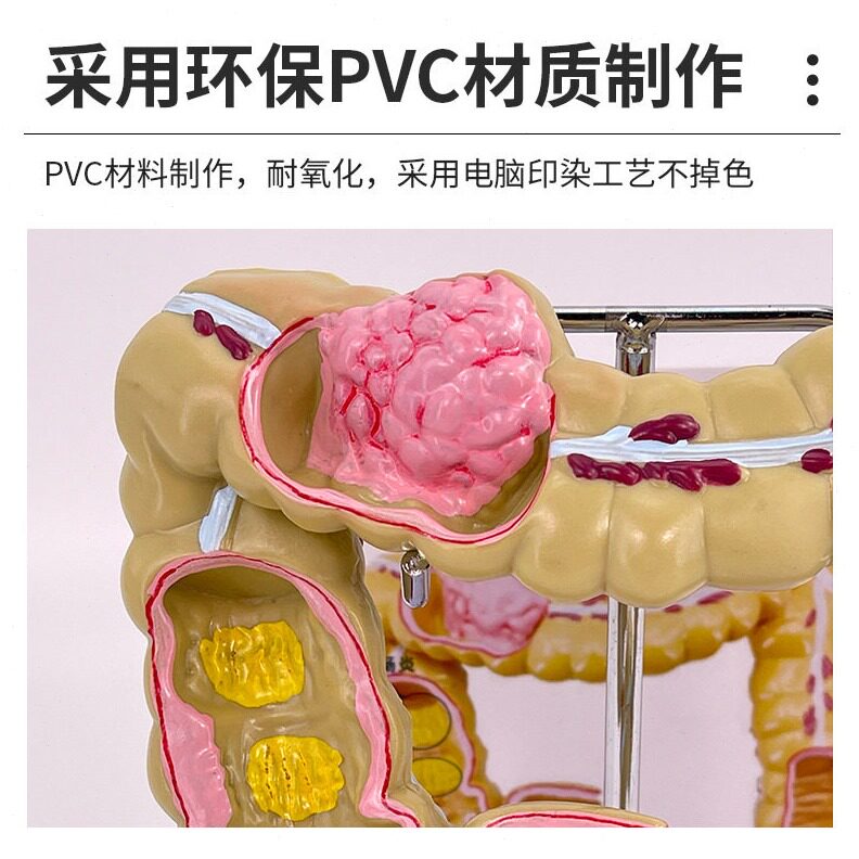 直销教学仿真结肠病理模型大肠直肠病变标本肠道医患沟通人体器官