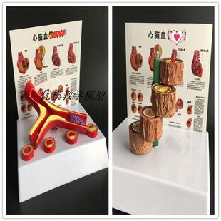 血管动脉化模型人体血管病变模型血管解剖医学教具血管解剖模型