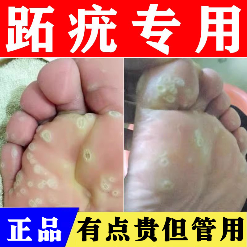 涂抹型、速发｜脚部跖疣专用