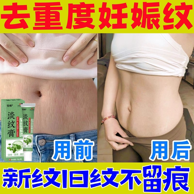 屈臣氏甄选祛除妊娠纹修复霜孕妇产后消除紧致去大腿妊辰纹肥胖纹