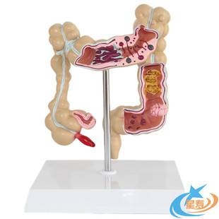人体结肠病变模型 大肠病理模型 直肠阑尾模型肛肠科医患沟通模型