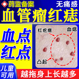 血管瘤血管痣专去除用药膏樱桃状血管瘤小红点蜘蛛痣疣点痣药水JY
