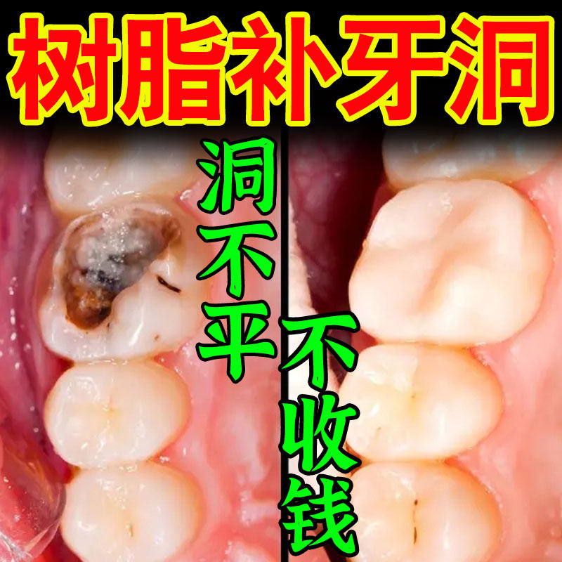 极速树脂补牙神器自己在家补牙z假牙烂牙填牙洞充填器剂膏牙科专