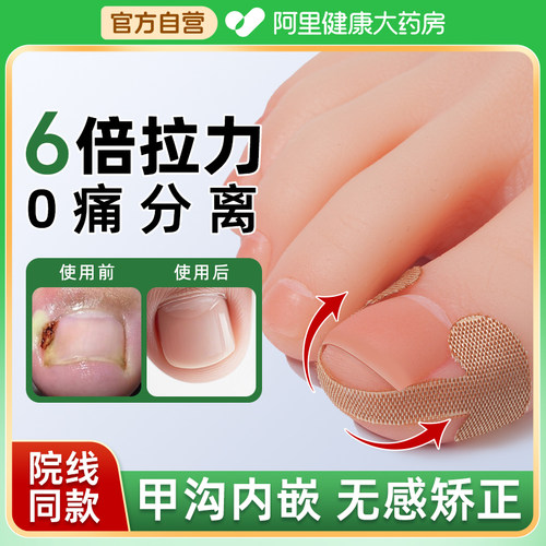 【医研级】甲沟矫正贴片