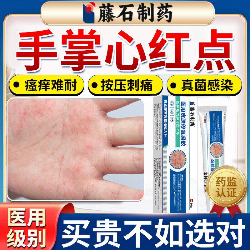 手掌心红点瘙痒脱皮湿疹专