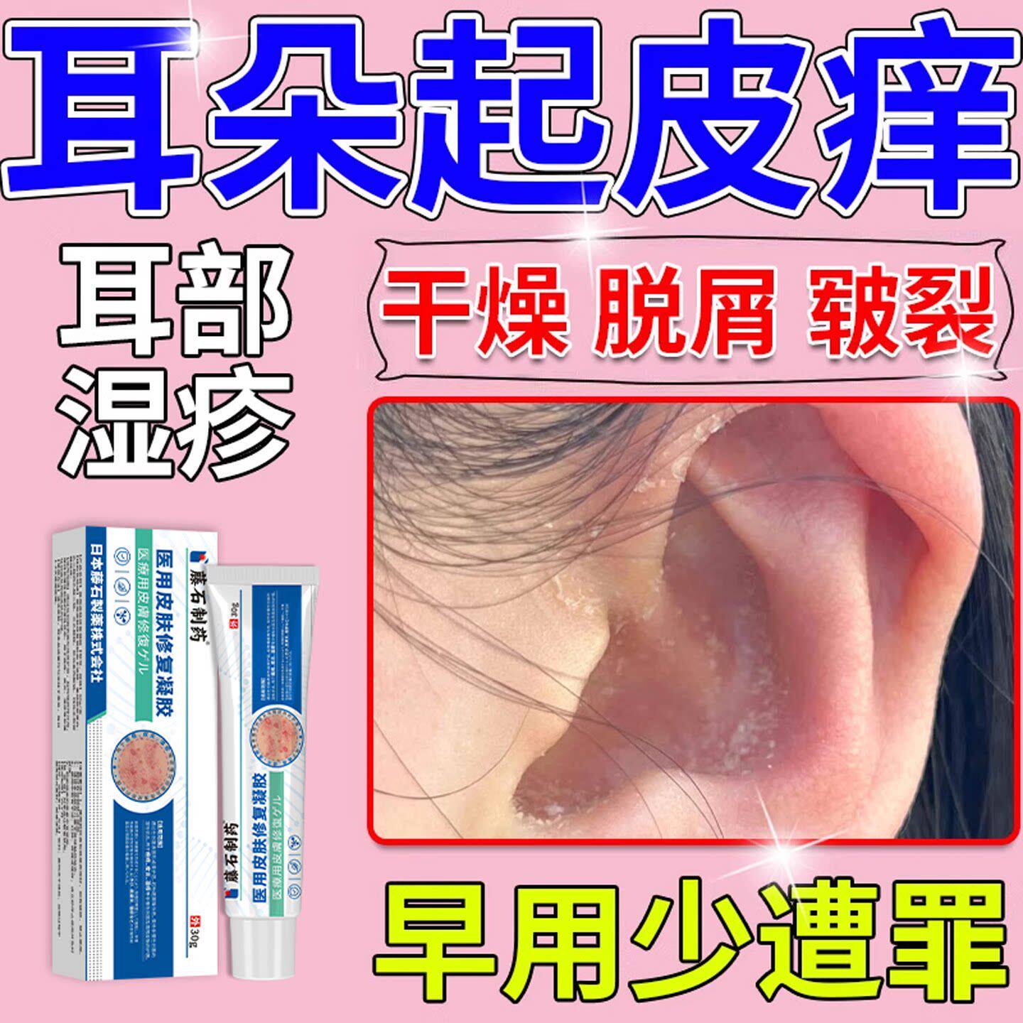 耳朵起皮干痒湿疹软膏外道