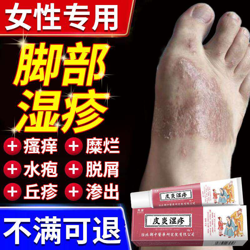 女性脚部湿疹皮炎背止痒起