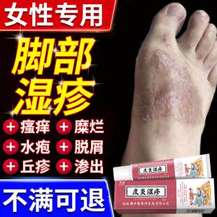 女性脚部湿疹皮炎脚背止痒起水泡去专用脚气膏干性角化型皮疹根FB