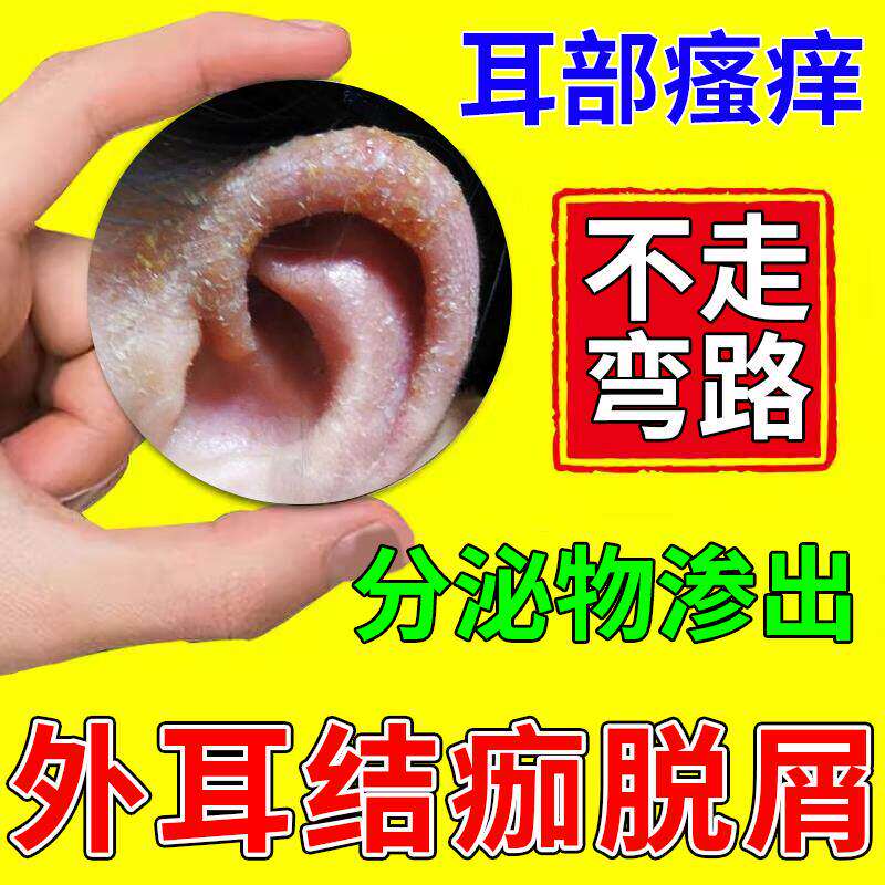耳朵湿疹膏结痂脱屑后道廓