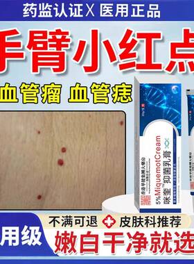 血管瘤痣去除可搭普萘洛尔