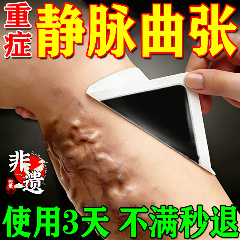 静脉曲张专用膏药贴青筋凸起红血丝血管堵塞肿胀瘙痒烂腿热敷膏药