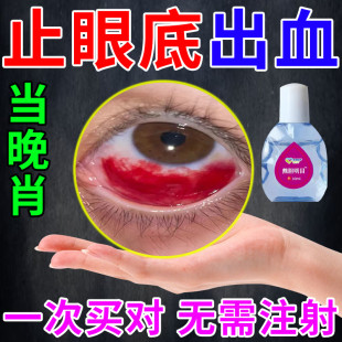 眼底出血眼水结膜充血眼睛淤血红血丝视物模糊眼里有异物感黄斑