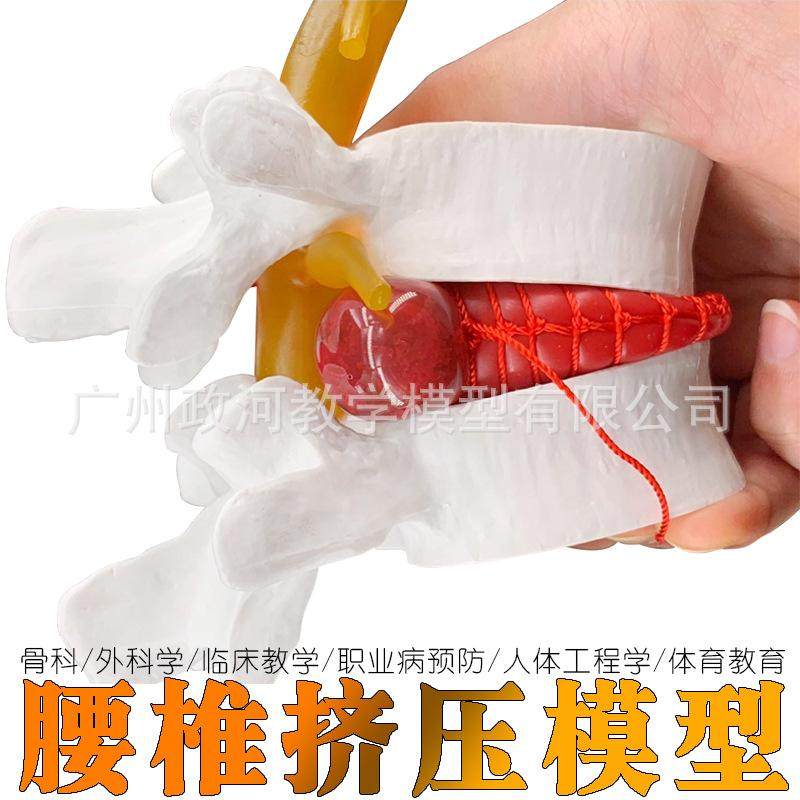 医用人体腰椎间盘突出演示模型 腰椎病变模型 骨科 病理腰椎突出