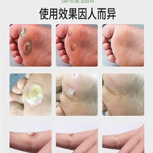 极速脚钉祛除h膏软化脚底根鸡茧老茧洁士胼胝贴硬死皮肉刺脚丁专
