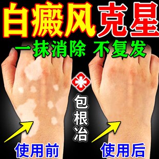 【康复疗程】补骨脂白斑抑菌液白风外用酊膏促黑色素汗斑净专用手