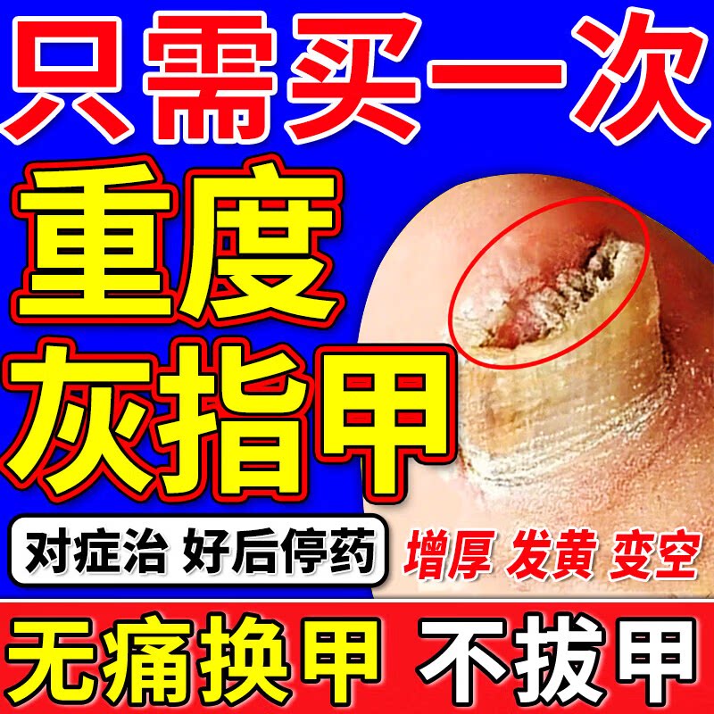 治疗灰指甲专用药正品旗舰店灰甲药膏甲沟炎药水真菌感染特非效zd