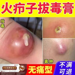 拔毒拔脓膏吸脓头屁股闷头火疖子硬块脓包M痘痘坐板疮吸浓包贴神