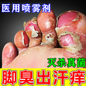脚臭根去专用特药效汗脚气烂脚丫药脱皮糜烂脚趾真菌感染喷雾剂