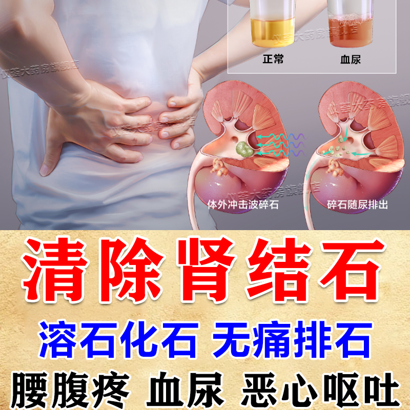 肾结石要吃什么药肾结石排石专用效特中药化石溶石腰腹疼痛血尿