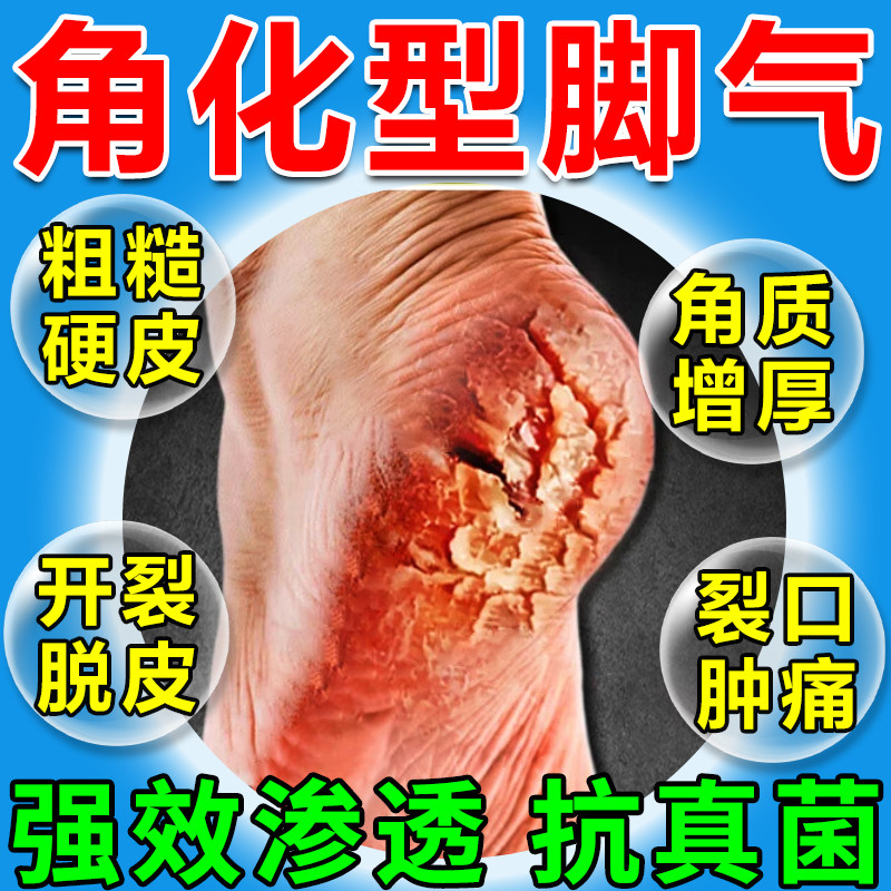 环吡酮胺乳膏抗真菌感染角化型脚气专用药脚跟后干裂粗糙脱皮痒
