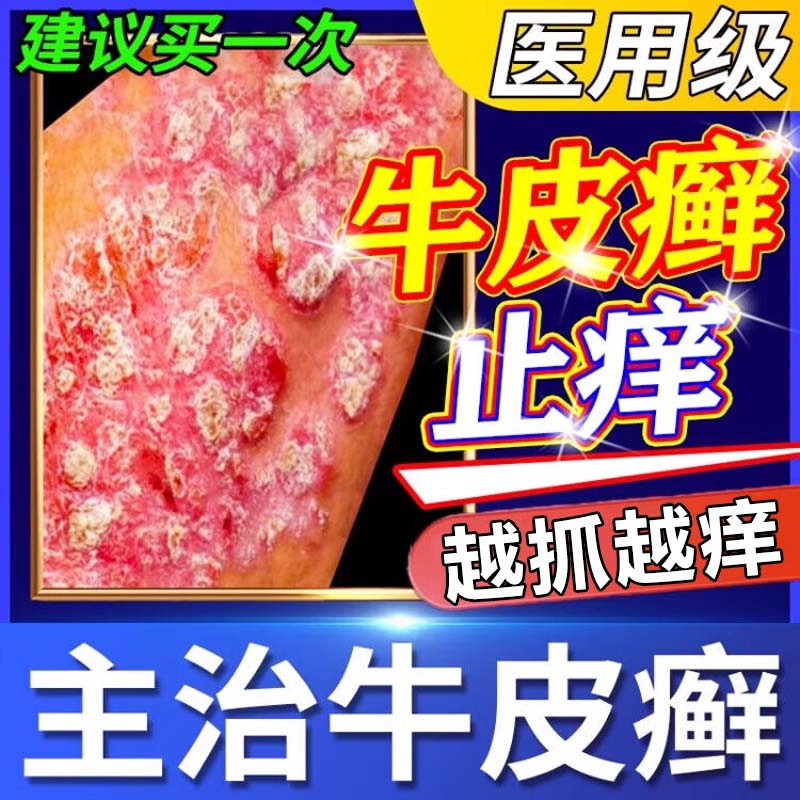 牛皮藓药膏皮肤病特痒真菌感染瘙痒止痒抑菌新效期药银屑病专用药