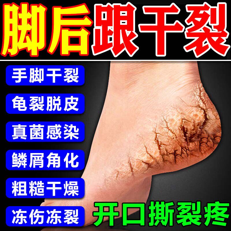 尿素维e乳膏正品脚干裂脱皮真菌感染专治疗脚后跟干皲裂口起硬皮