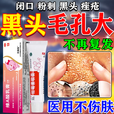 异维a酸红霉素软膏去黑头收缩毛孔粗大粉刺深层清洁闭口痤疮痘印