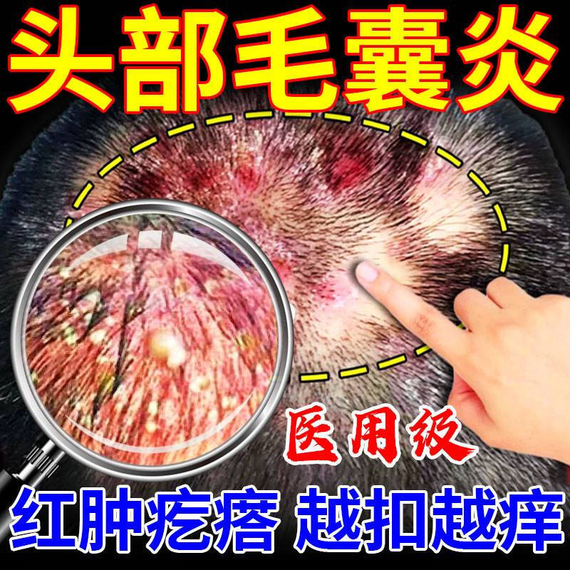 头痒有疙瘩痤疮脂溢性皮炎真菌感染毛囊炎特别效药膏脂溢性皮炎